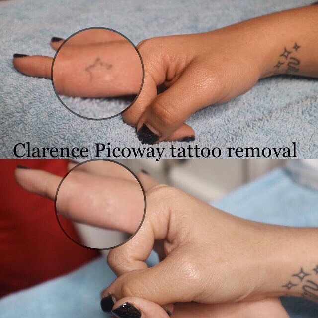 PicoWay Tattoo Removal